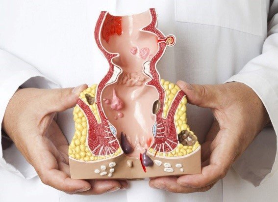 Αιμορροΐδες