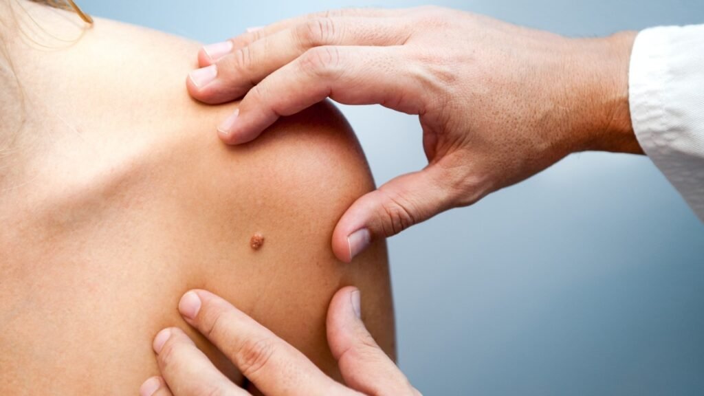 BCC Βασικοκυτταρικό Καρκίνωμα