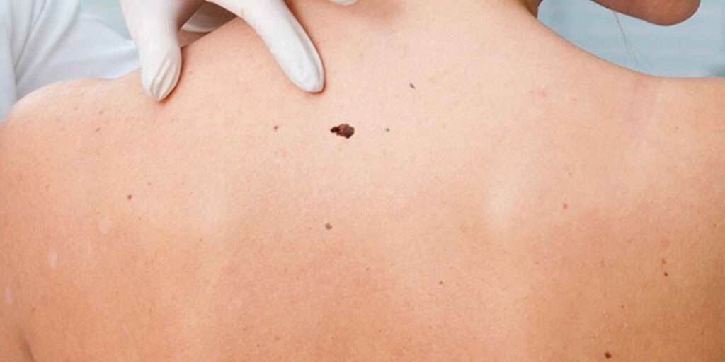 Ακανθοκυτταρικό Καρκίνωμα