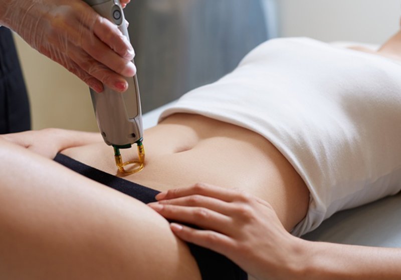 Αποτρίχωση Γυναίκα