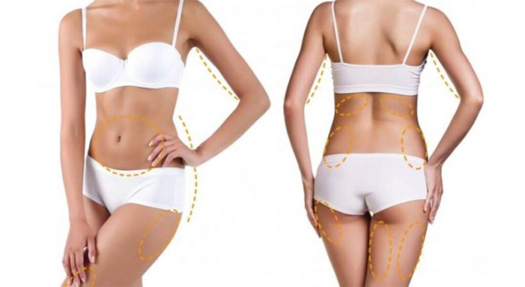 Κρυολιπόλυση