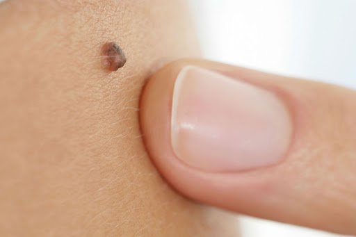 Σπίλοι – Ελιές