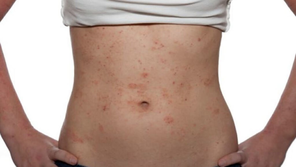 Ατοπική Δερματίτις – Έκζεμα