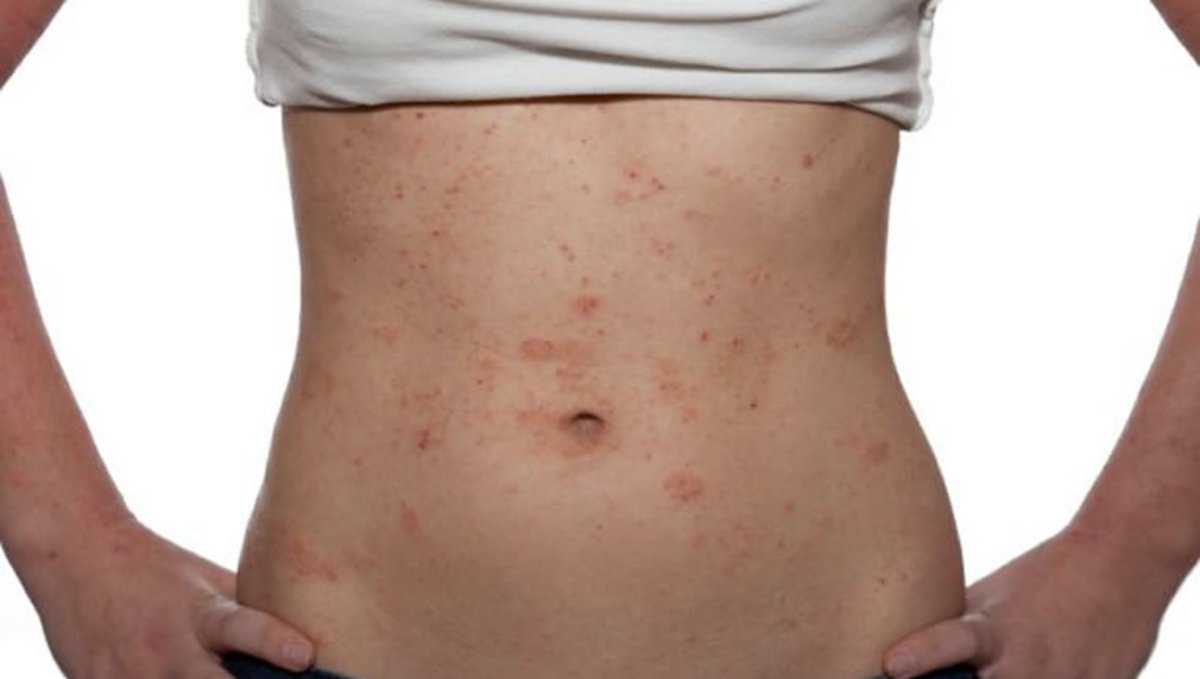 Ατοπική Δερματίτις – Έκζεμα