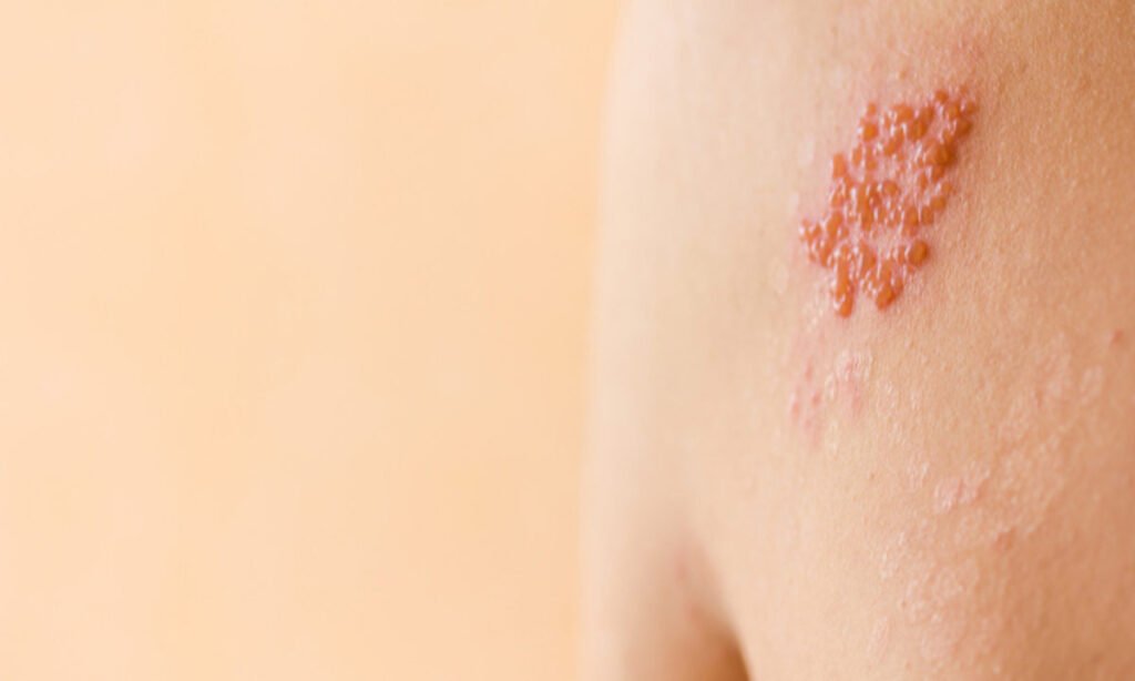 Έρπης ζωστήρ