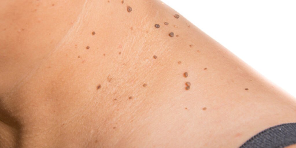 Θηλώματα προσώπου βλεφάρων κορμού