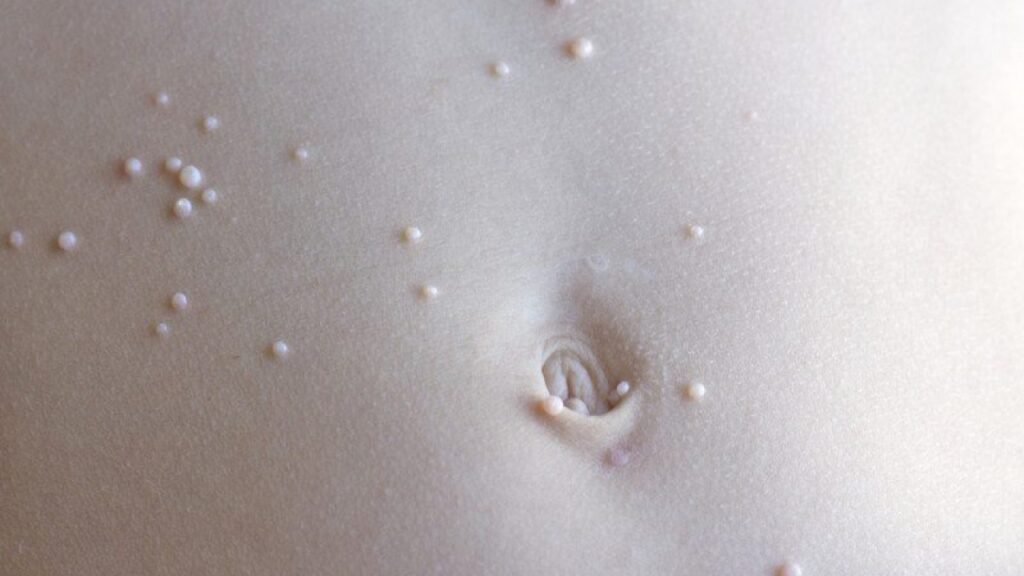 Μολυσματική Τέρμινθος