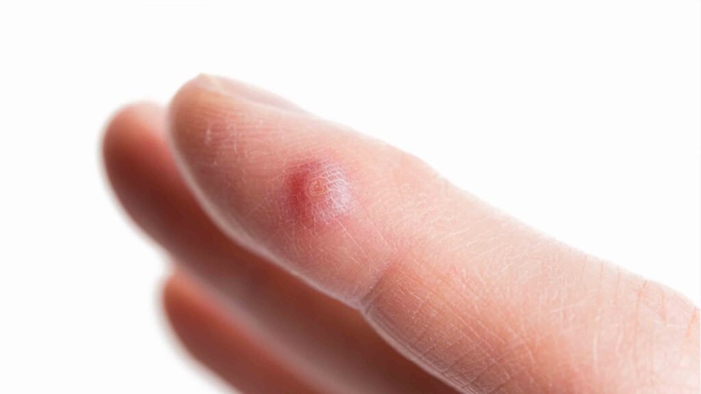 Ιογενείς μυρμηγκιές – HPV