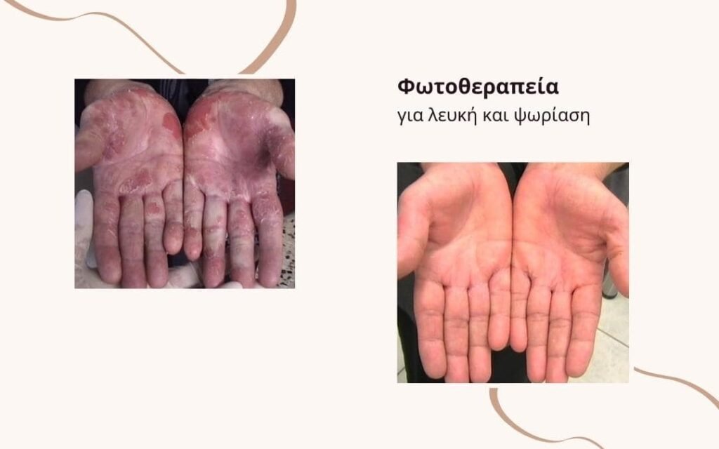 Μονάδα Φωτοθεραπείας για αυτοάνοσα νοσήματα