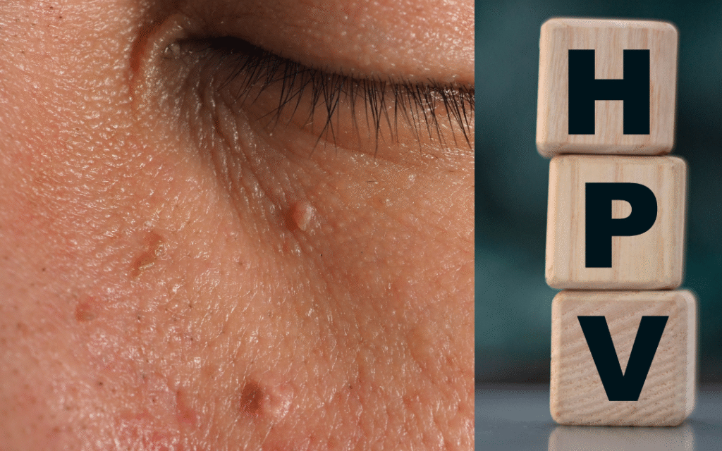 Θηλώματα, HPV κονδυλώματα σώμα και περιγεννητική περιοχή