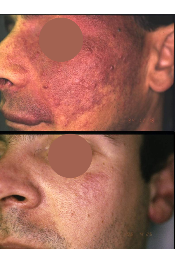 Τι είναι τα αιμαγγειώματα; Αιτίες – Θεραπεία & Αντιμετώπιση