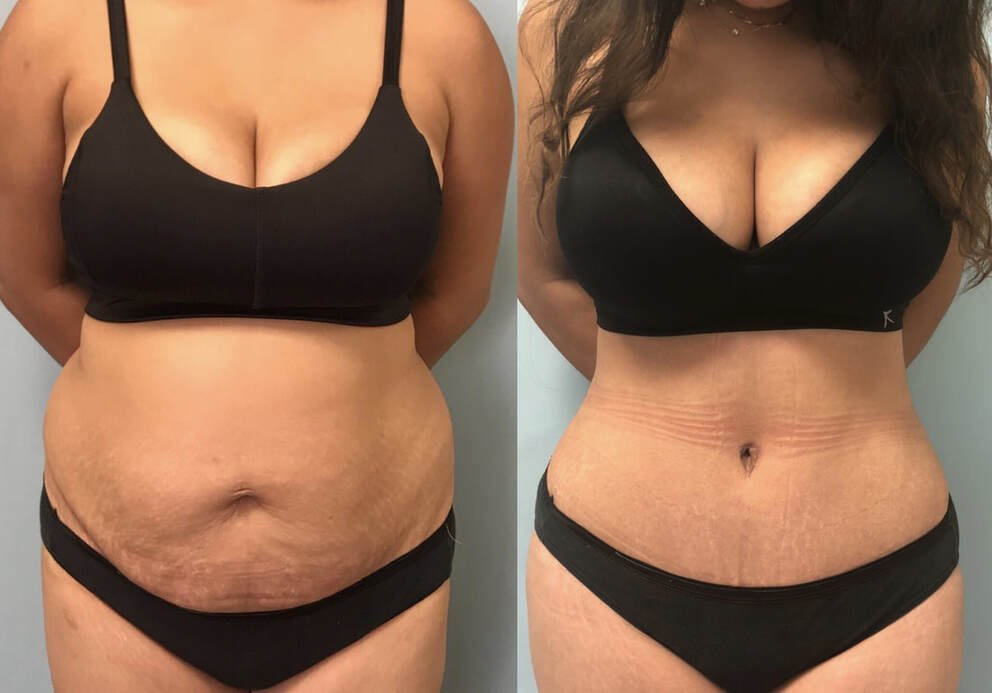 Κοιλιοπλαστική